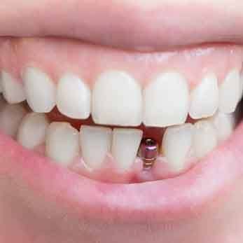Smile with dental implant