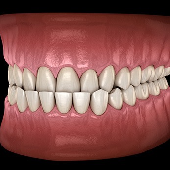 Digital image of an underbite