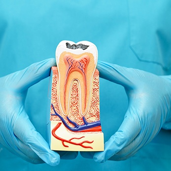 Factors that could influence the cost of your root canal include the location of the infected tooth