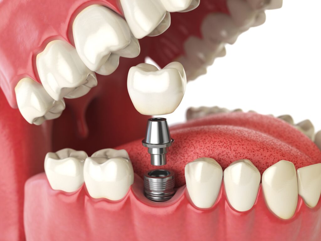 3D rendering of a dental implant and its parts in a lower arch with white background