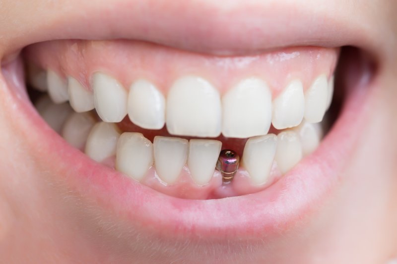 Smile with implant